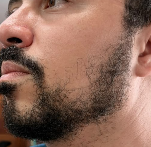 Depois do procedimento