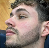 Depois do procedimento