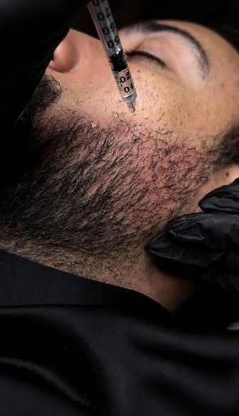 Tricologia e Protocolo Barba Cheia